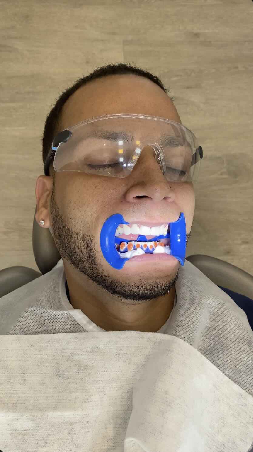 Sesión de blanqueamiento dental profesional en Christian Salazar Odontología Digital, Bogotá